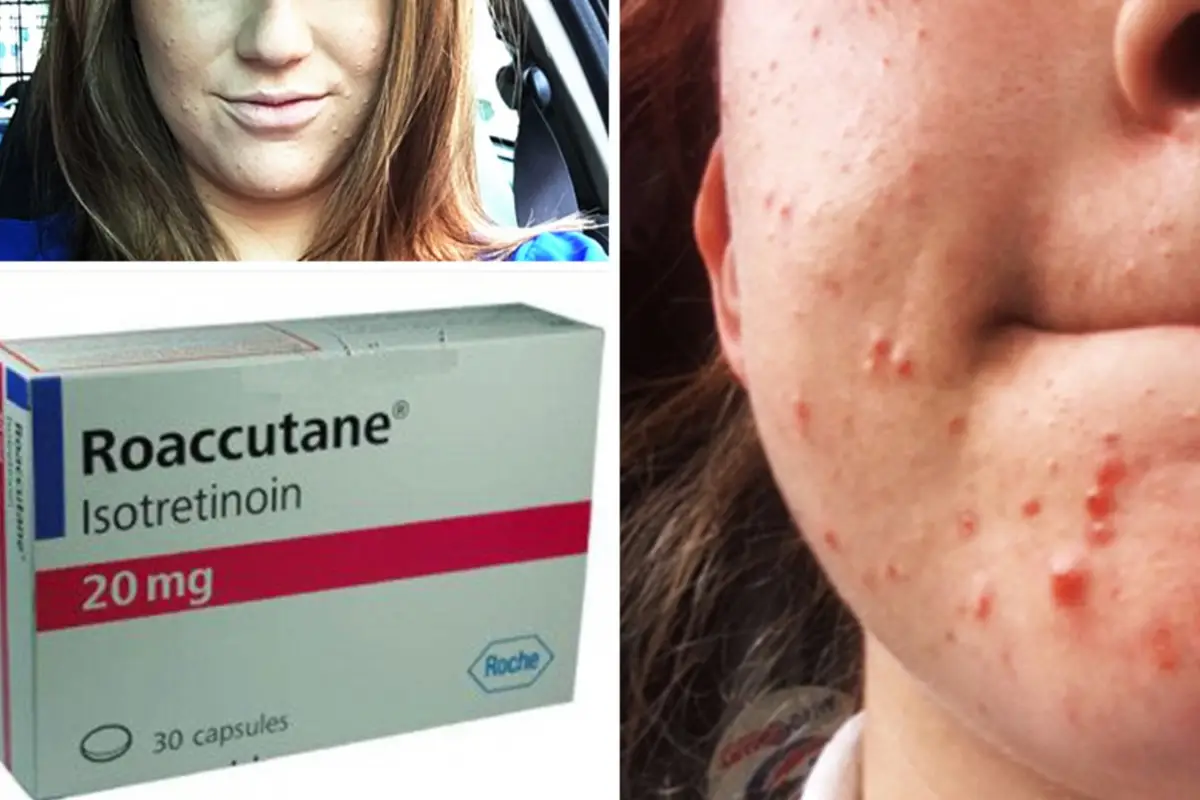 Roaccutane Nasıl Kullanılır?