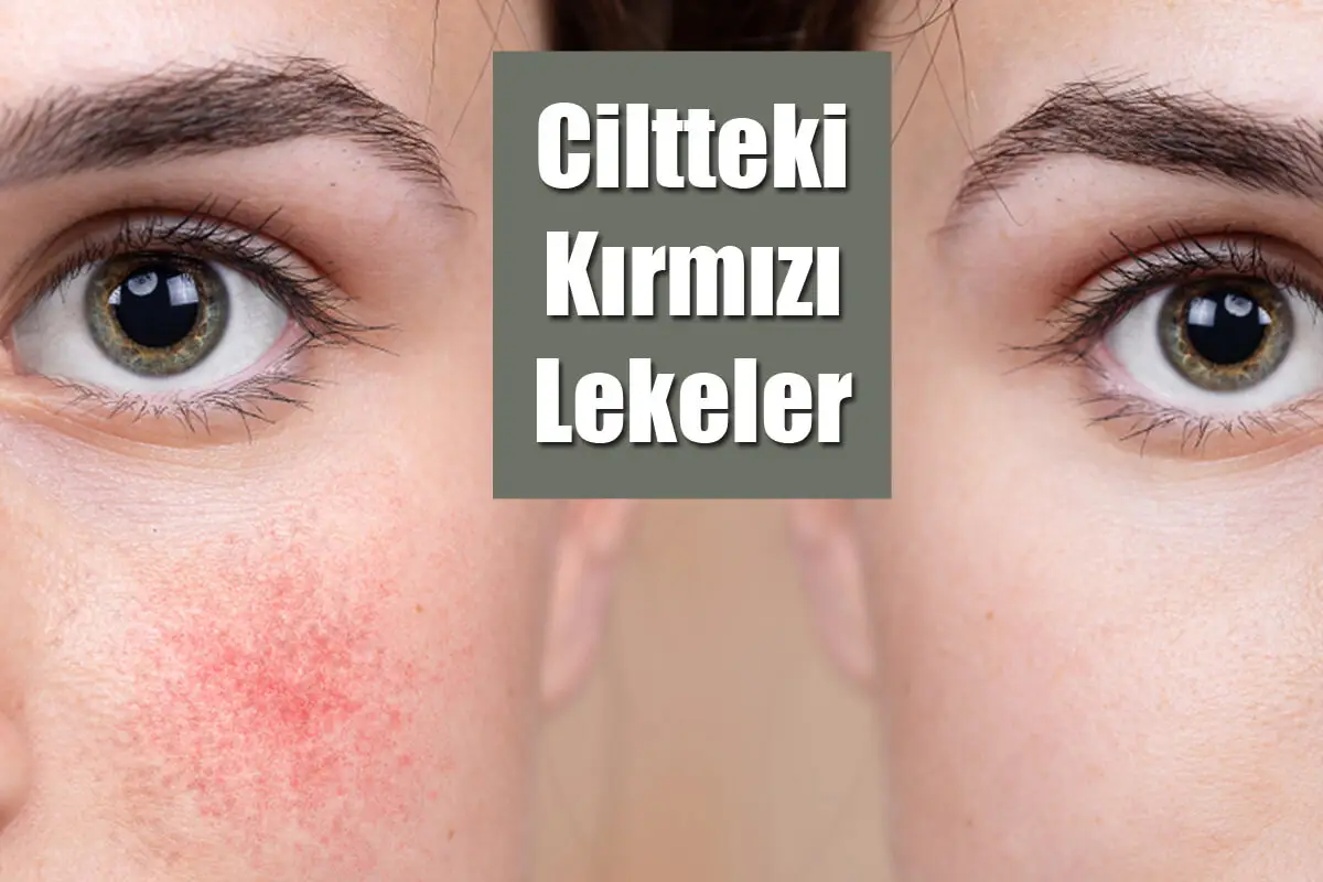 Ciltteki Kırmızı Lekeler Tedavi Yöntemleri