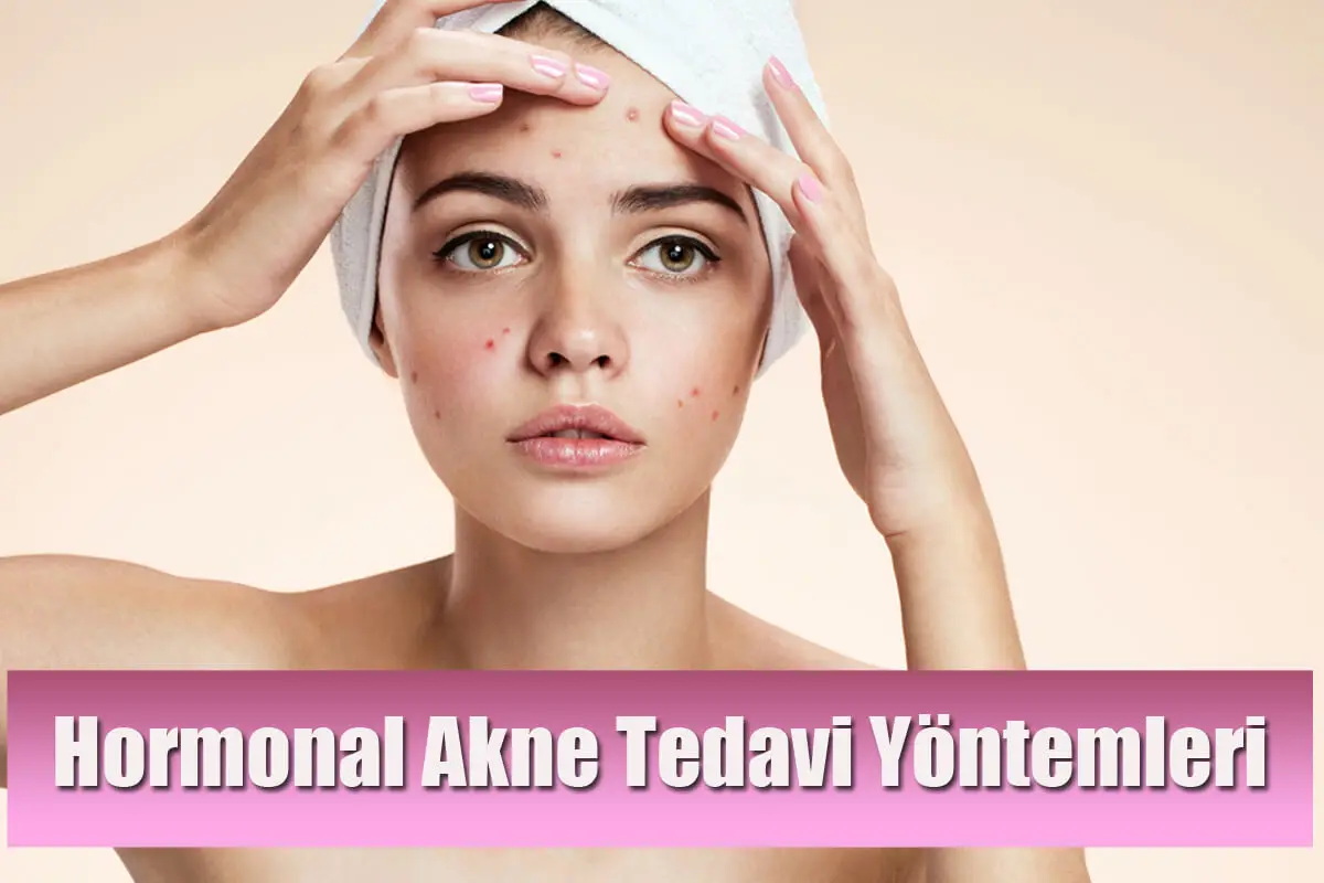 Hormonal Akne (Sivilce) Nedir, Neden Oluşur ve Tedavi Yöntemleri Nelerdir?