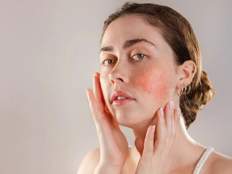 Kırmızı Cilt Lekeleri Bitkisel Tedavi Yöntemleri