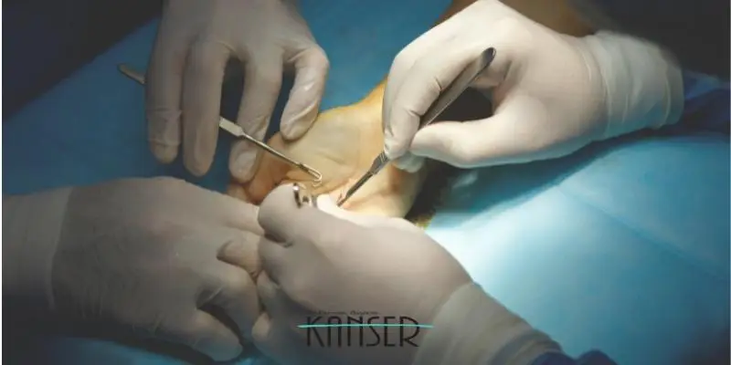 Miyom Ameliyatı - Dr. Derman Başaran Anlatıyor 1 Miyom Ameliyatı