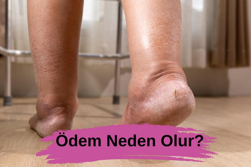 Ödem Neden Olur?