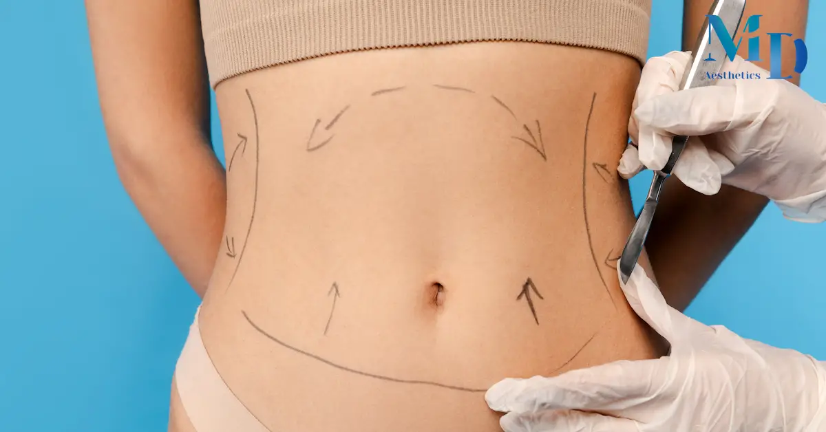 Vaser Liposuction: Vücut Şekillendirmede Modern ve Hassas Bir Yöntem