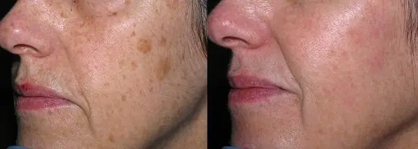 dermapen leke tedavisi