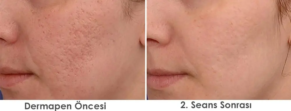 dermapen öncesi sonrası
