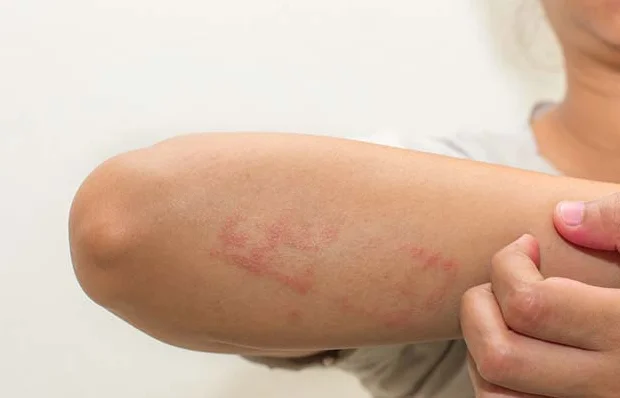 Egzama Kaşıntısına Ne İyi Gelir? 2 Egzamanın Tedavi Yöntemleri