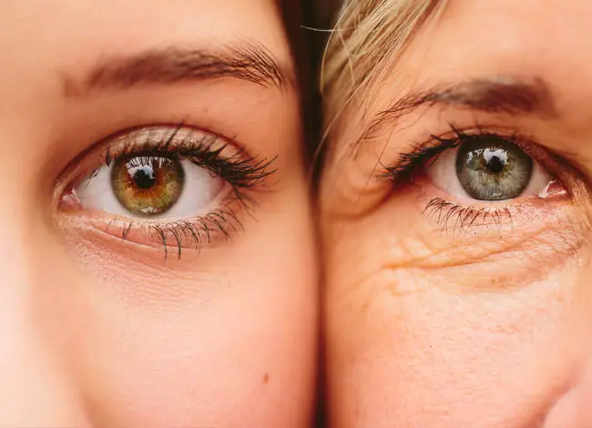 Göz Altı Kırışıklıkları Nasıl Giderilir? 1 Göz Altı Kırışıklıkları Nasıl Giderilir? 1