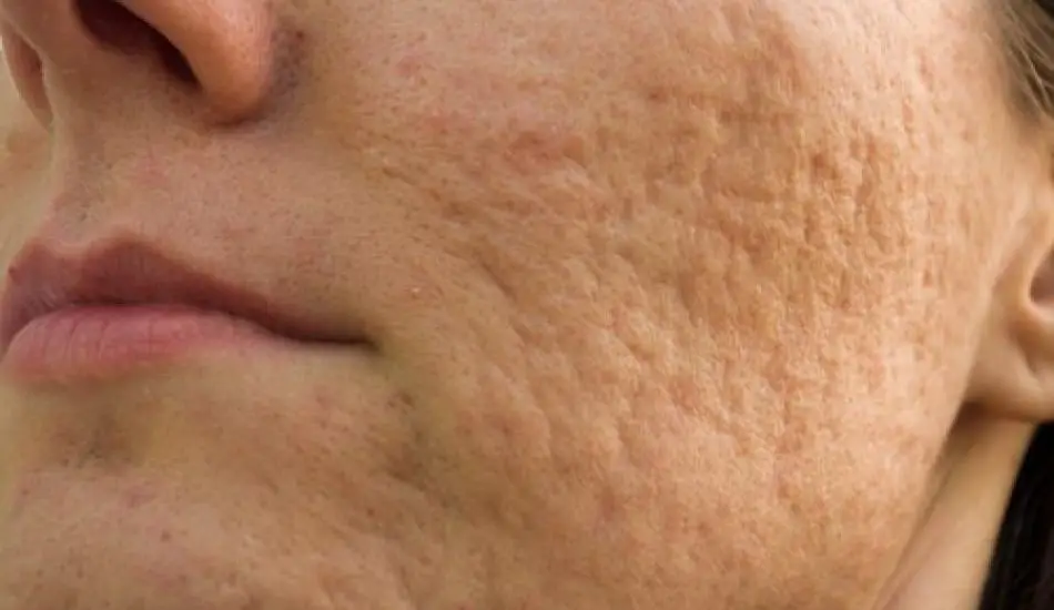 Sivilce izleri için maske tarifleri | Yüzdeki sivilce lekeleri nasıl geçer?