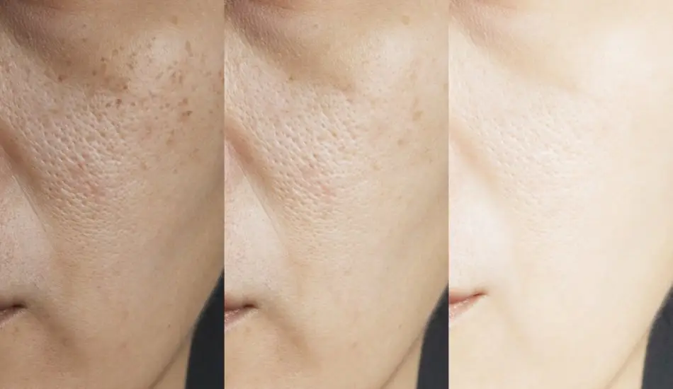 Yüzde Oluşan Delik ve Çukurlar Nasıl Geçer? Yüzde Delik Neden Olur?