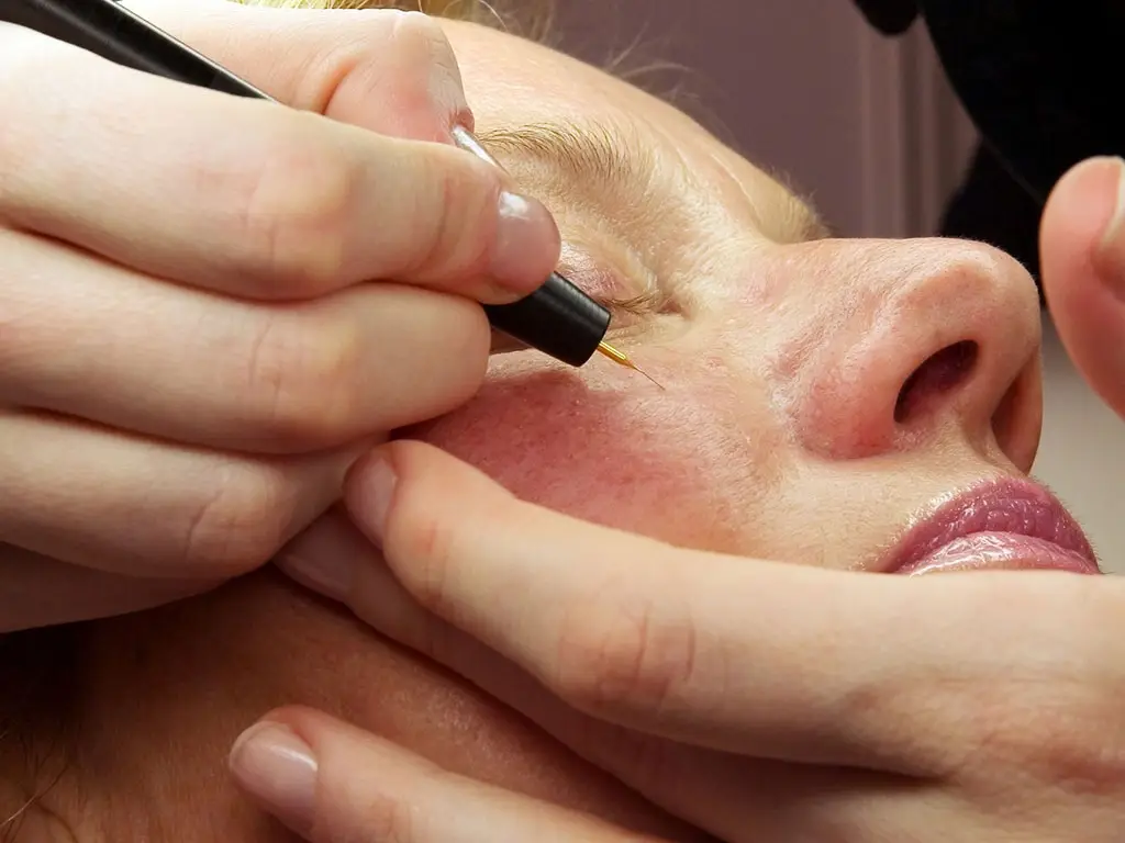 Yüzde Kılcal Damarlar Neden Oluşur?